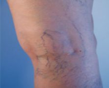 What to Expect from Sclerotherapy for Spider Veins