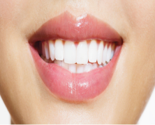 Improve Your Smile and Confidence in Edmond, KS with Dental Veneers