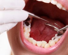 The Benefits of Composite Dental Fillings in Salisbury, NC