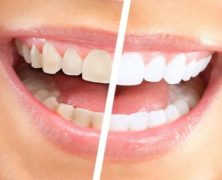 Should You Get Teeth Whitening in Macon, GA?
