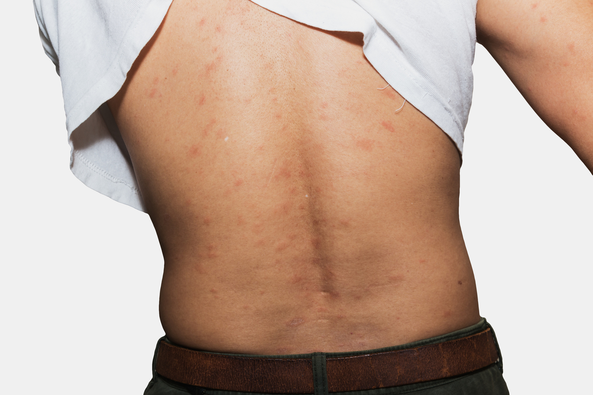 The Things to Look For in the Best Cream for Shingles in Utah