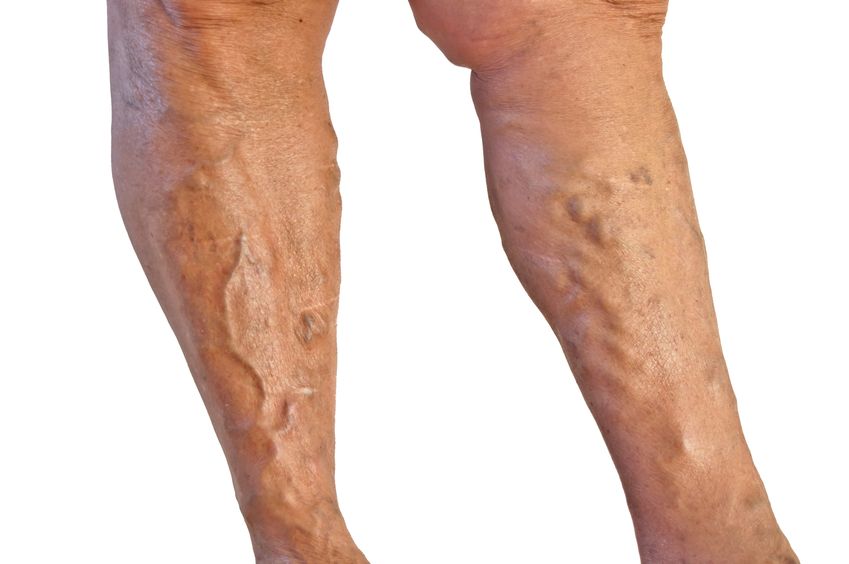 Varicose and Spider Vein Removal in Schaumburg IL