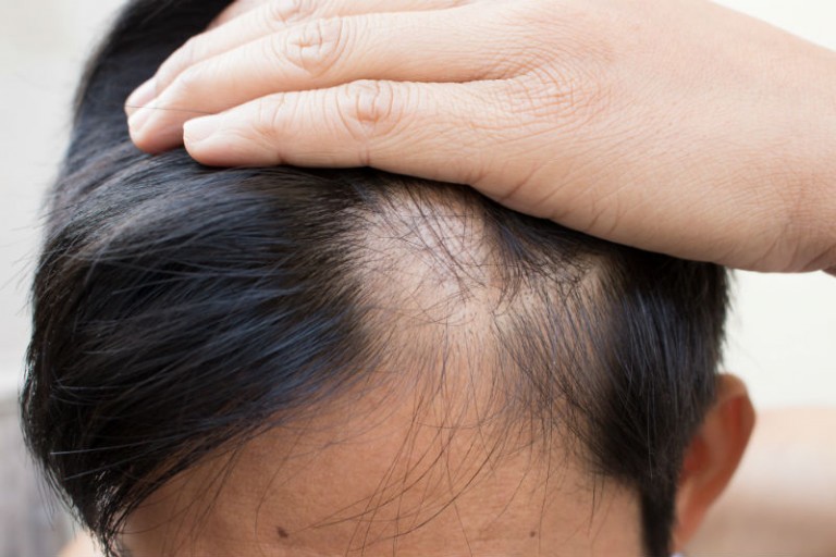 Signs That You Could Benefit From Getting a Hair Transplant in NYC