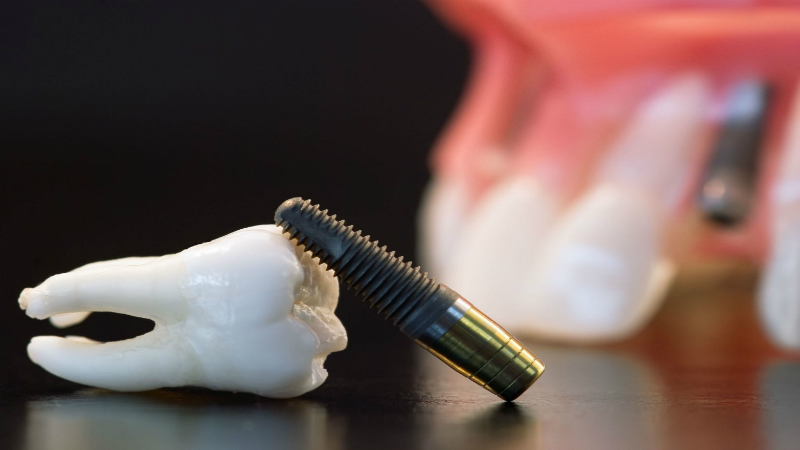 Emergency Dentist in Fairfax Talks About Preventing a Dental Emergency