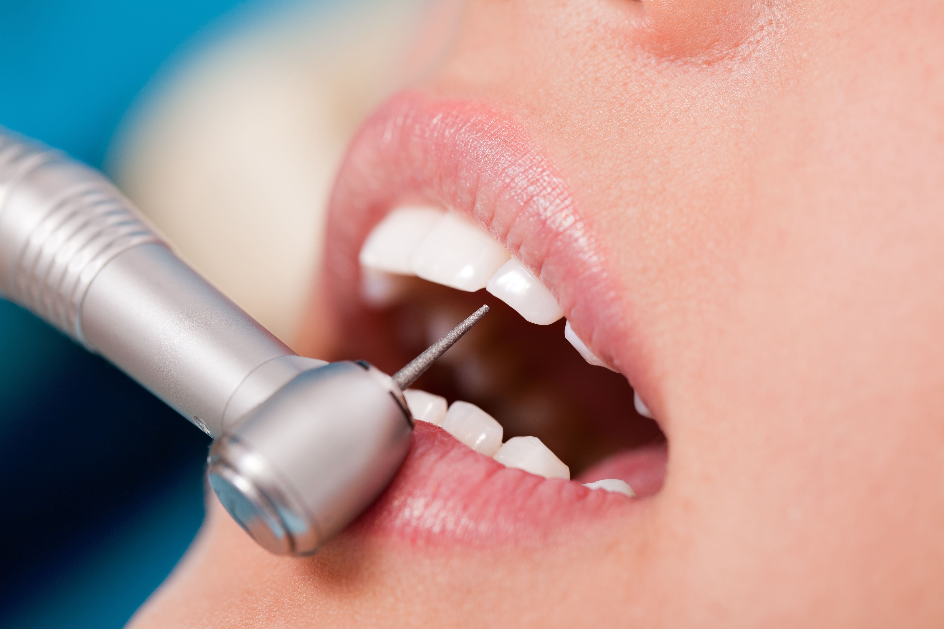 Same-Day Implants in Centreville Help You Get Your Oral Health in Line