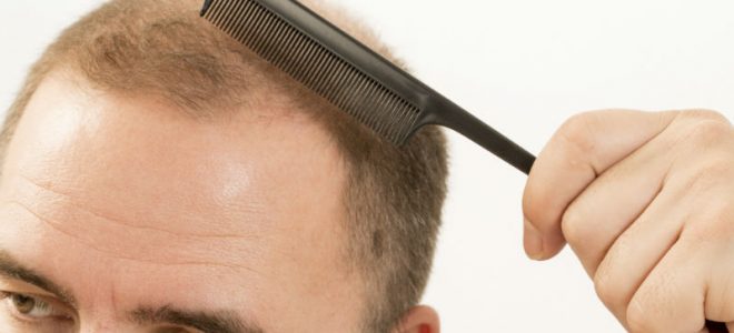 Debunking Myths Associated with Hair Loss Treatment in Florida