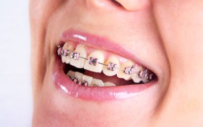 Affordable Solutions For Braces In Medina OH Residents Seeking Straighter Smiles